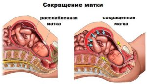 Почему матка бывает в тонусе. Тонус матки: последствия, лечение, симптомы, причины