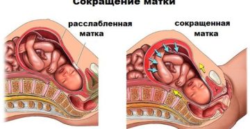 Почему матка бывает в тонусе. Тонус матки: последствия, лечение, симптомы, причины