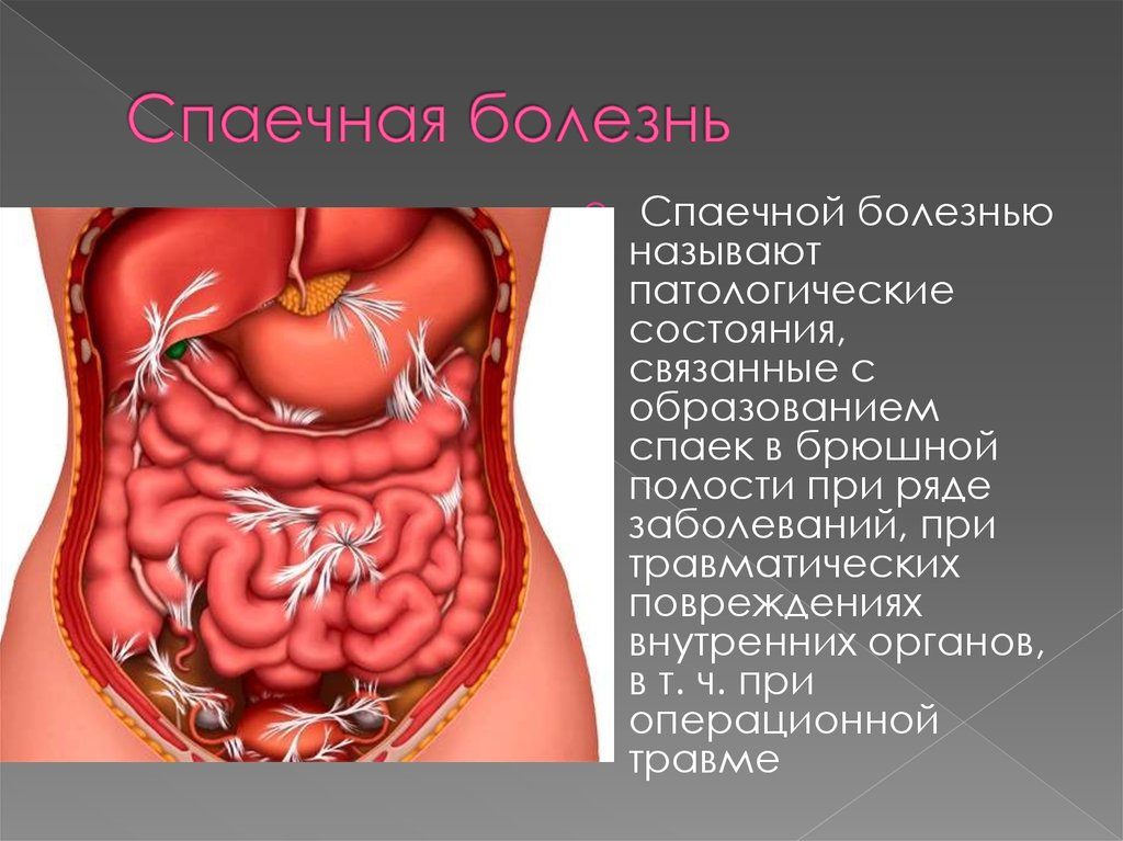 Гимнастика при спаечной болезни кишечника. Лечение кишечных спаек. Описание кишечной патологии.