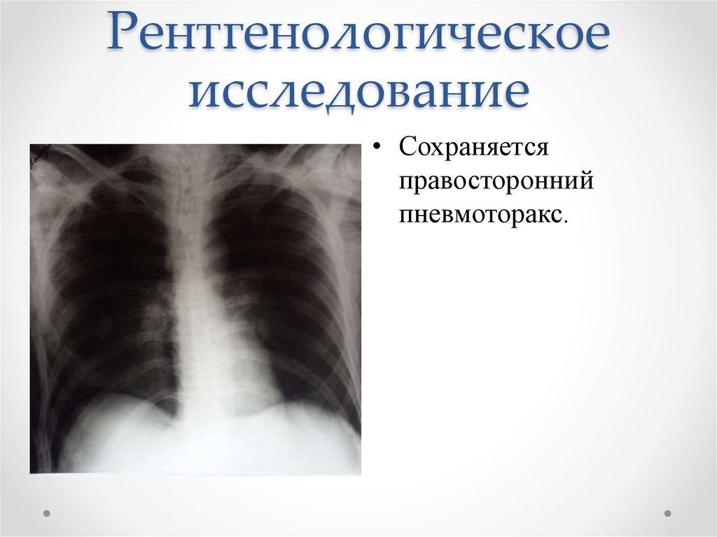 Обзор по рентгенологической диагностике пневмоторакса. Пневмоторакс: рентгенологическая диагностика Спонтанный пневмоторакс рентгенологическая картина