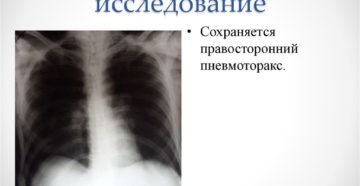 Обзор по рентгенологической диагностике пневмоторакса. Пневмоторакс: рентгенологическая диагностика Спонтанный пневмоторакс рентгенологическая картина