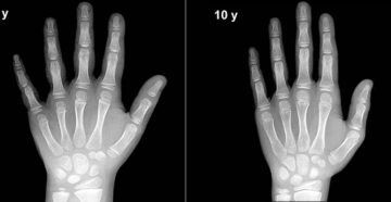 Как определить костный возраст по рентгену кисти. Определение возраста по костям