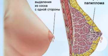 Выделение жидкости из грудных желез у женщин. Темные выделения из молочных желез при надавливании. Действия при появлении выделений из сосков