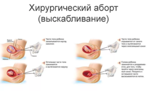 Тошнит после медикаментозного прерывания беременности что делать. Возможные осложнения и последствия медикаментозного аборта. Боли и спазмы после медикаментозного аборта