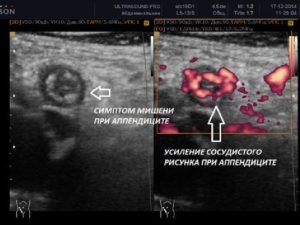 Можно ли диагностировать аппендицит по узи. Что показывает исследование? Атипичные положения аппендикса