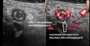 Можно ли диагностировать аппендицит по узи. Что показывает исследование? Атипичные положения аппендикса