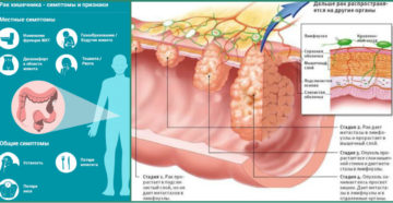 Симптомы рака кишечника у женщин. Рак кишечника: статистика. Рак кишечника: признаки и симптомы, стадии, лечение.
