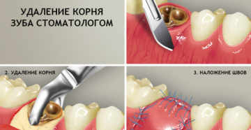 Больно ли удалять корни разрушенных зубов. Последствия оставшегося в десне корня. Является ли лечение корня зуба болезненной процедурой