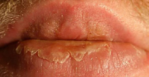 Трещины на половых губах при молочнице. Трещины на половых губах - причины, лечение