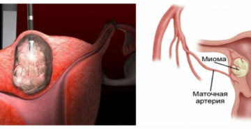 Рассасывается ли миома матки? Чем опасна миома матки и может ли она рассосаться сама