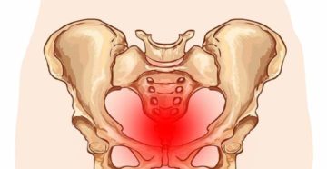 Почему возникают боли в области таза после родов и как их уменьшить? Причины боли в лобковой кости после родов