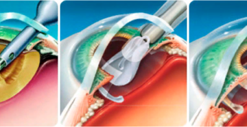 Архив метки: подшивание ИОЛ. Какие осложнения после операции катаракты