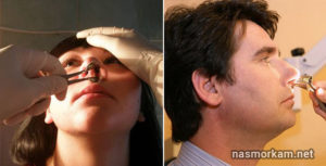 Боль внутри носа причины и лечение. Причины и лечение болей в носу внутри, снаружи, кончика при нажатии или прикосновении
