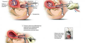 До какого срока делают вакуумный аборт, как он проходит, каковы последствия прерывания беременности? Вакуумное прерывание беременности: сроки и отзывы