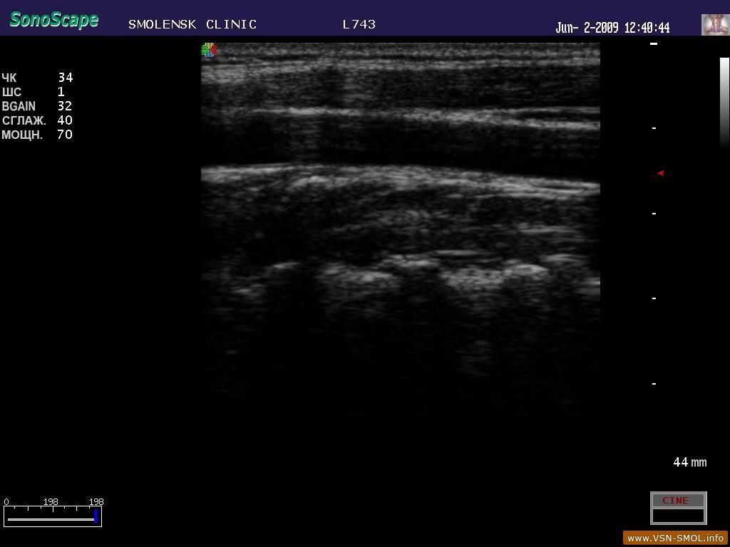 Узи сонных артерий как называется. Узи сонных и позвоночных артерий. Ультразвуковое исследование артерий шеи