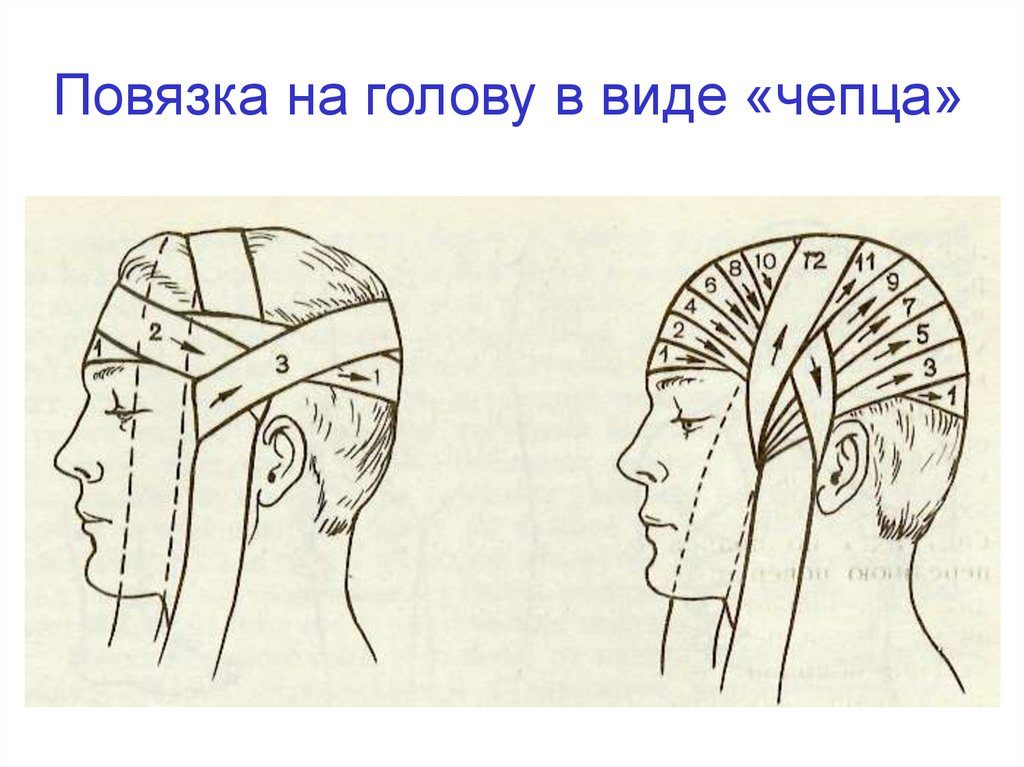 Медицинская повязка на голову как называется. Повязка чепец - техника наложения. Десмургия