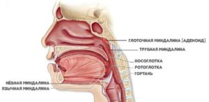 Гиперплазия язычной миндалины: симптомы, лечение, профилактика