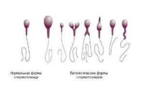 Астенотератозооспермия. Астенотератозооспермия — низкая подвижность сперматозоидов и нарушение их структуры