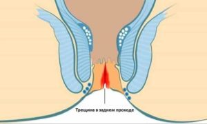 После родов трещинка в заднем проходе геморой причины кровит. Как лечить трещины в заднем проходе после родов