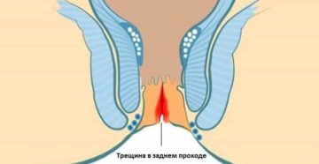 После родов трещинка в заднем проходе геморой причины кровит. Как лечить трещины в заднем проходе после родов