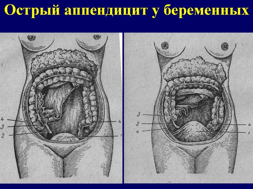 Аппендицит после родов. Острый аппендицит и беременность