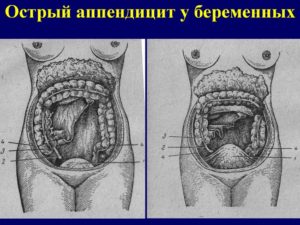 Аппендицит после родов. Острый аппендицит и беременность