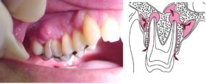 Воспаление надкостницы зуба лечение народными средствами. Чем опасно воспаление надкостницы зуба и методы его лечения