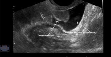 Жидкость в позадиматочном пространстве. Причины скопления жидкости за маткой