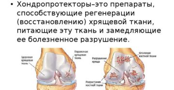 Стимулятор восстановления хрящевой ткани. Методы регенерации хрящевой ткани