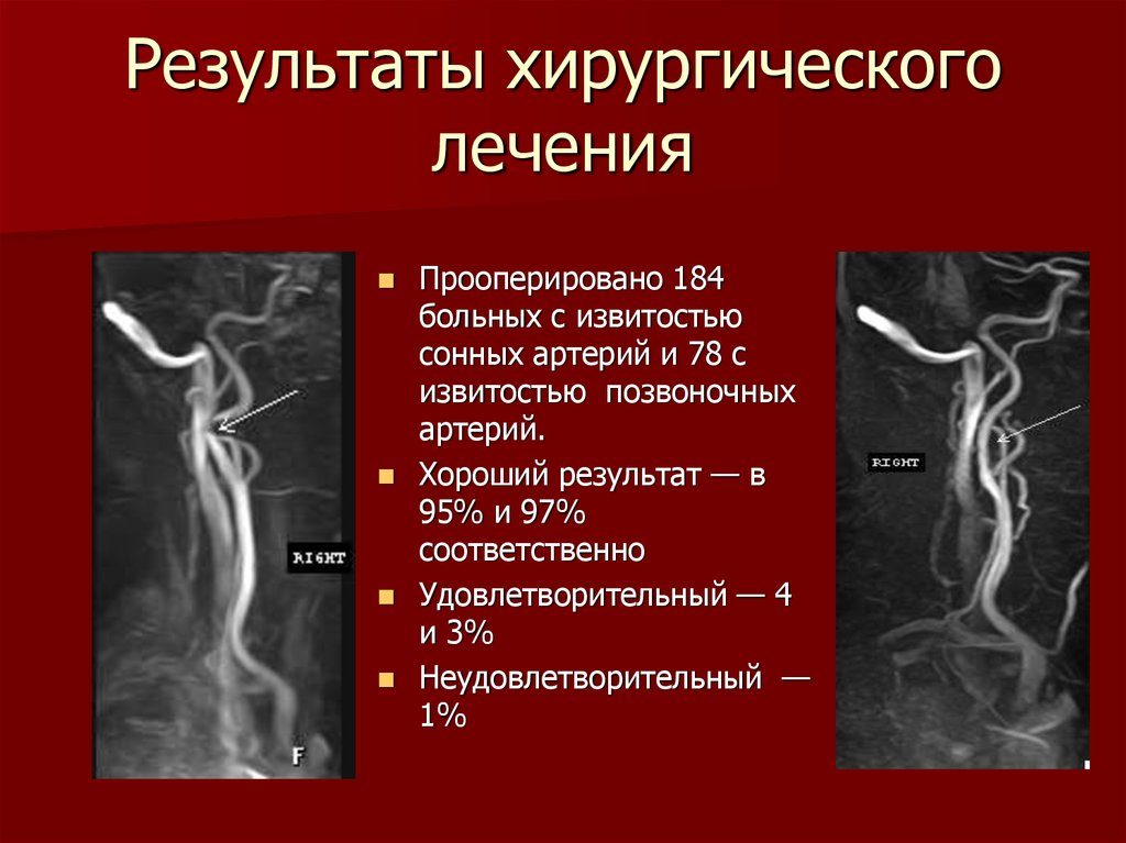 Когда s образная извитость сонных артерий мешает. Симптомы и лечение извитости позвоночных артерий