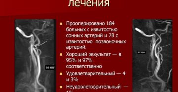 Когда s образная извитость сонных артерий мешает. Симптомы и лечение извитости позвоночных артерий