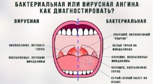 Может ли от зуба мудрости болеть горло? Может ли болеть горло из-за зуба