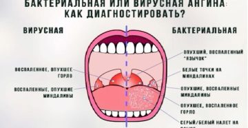 Может ли от зуба мудрости болеть горло? Может ли болеть горло из-за зуба