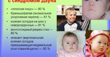 Почему дети с синдромом дауна все на одно лицо. Физическое и умственное развитие. Формы синдрома Дауна