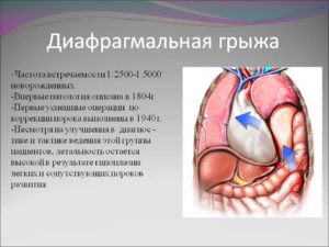 Чем опасна диафрагмальная грыжа у новорожденных. Диафрагмальная грыжа у новорожденных