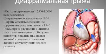 Чем опасна диафрагмальная грыжа у новорожденных. Диафрагмальная грыжа у новорожденных