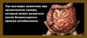 Что делать, если появился запор после приема антибиотиков