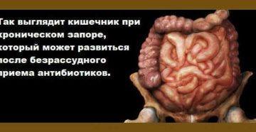 Что делать, если появился запор после приема антибиотиков