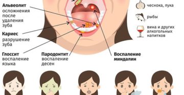 О чем говорит состояние, когда дурно пахнет изо рта у ребенка? Запах изо рта после удаления аденоидов: причины, лечение