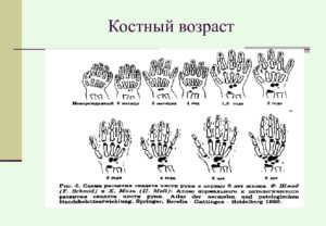 Возраст костный. Костный возраст