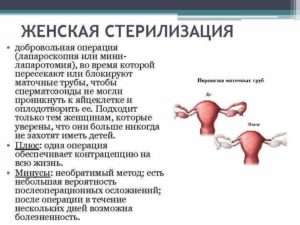 Женская стерилизация плюсы и минусы. Показания к стерилизации женщин. Кто может использовать трубную окклюзию