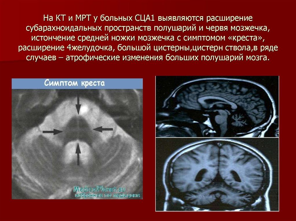 Кистовидное расширение субарахноидального пространства мозжечка. Что представляет собой субарахноидальное пространство