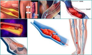 Может ли тромб рассосаться самостоятельно. Лечение тромбоза сосудов народными средствами