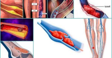 Может ли тромб рассосаться самостоятельно. Лечение тромбоза сосудов народными средствами