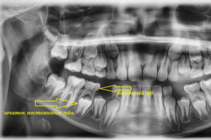 Нет зачатков коренных зубов что делать. Бывают ли у взрослых молочные зубы