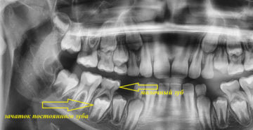 Нет зачатков коренных зубов что делать. Бывают ли у взрослых молочные зубы