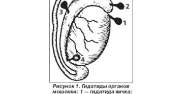 Перекрут гидатиды яичка: что это такое, диагностика заболевания, лечение. Причины возникновения и лечение гидатиды яичника