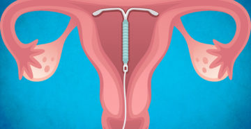 Внутриматочная спираль (ВМС). Что делать, если сместилась внутриматочная спираль? Если не ощущается усы от спирали