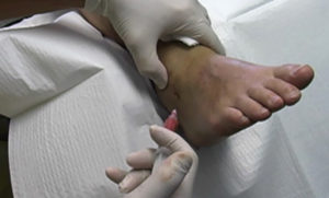 Лечение некроза кожи мягких тканей народными средствами. Лечение некрозов Некроз тканей ноги лечение в домашних условиях