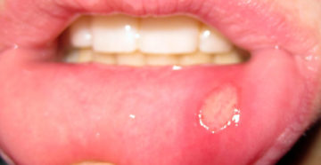 Болячка на внутренней стороне губы чем лечить. Как лечить язву внутри на губе лекарственными препаратами